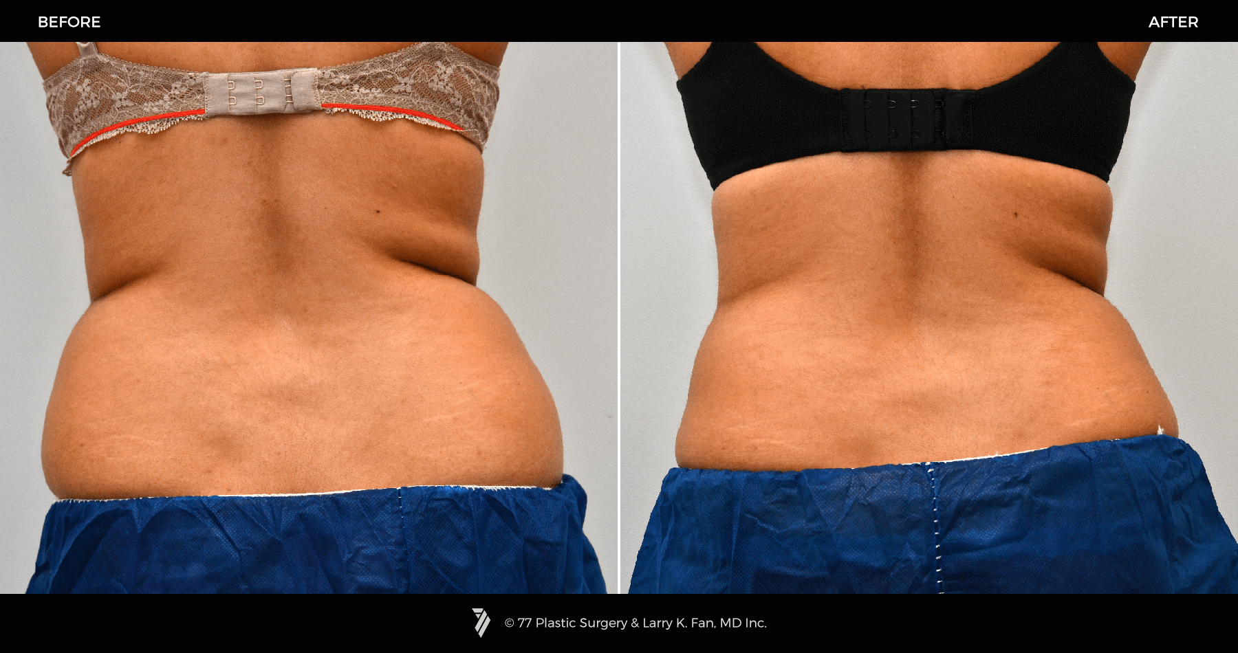5-coolsculpting-before-and-after-stories-and-how-to-get-the-same-results